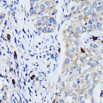 MAP1LC3B / LC3B Antibody - Immunohistochemistry of paraffin-embedded human lung cancer tissue.