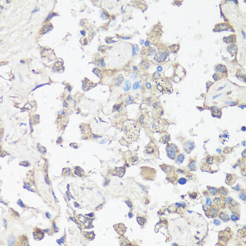 MAP1LC3B / LC3B Antibody - Immunohistochemistry of paraffin-embedded human lung cancer using MAP1LC3B antibody at dilution of 1:100 (40x lens).
