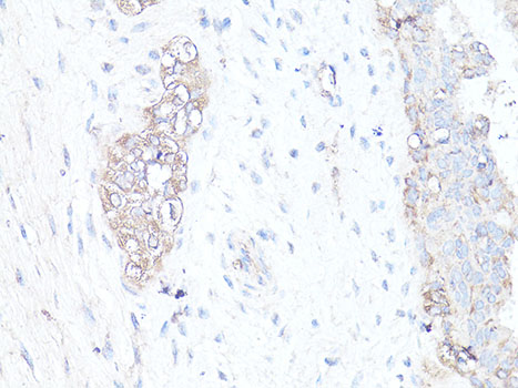 MAP1LC3B / LC3B Antibody - Immunohistochemistry of paraffin-embedded human breast cancer using MAP1LC3B antibody at dilution of 1:100 (40x lens).
