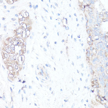 MAP1LC3B / LC3B Antibody - Immunohistochemistry of paraffin-embedded human mammary cancer using MAP1LC3B antibody at dilution of 1:100 (40x lens).