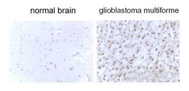 MAP1LC3B / LC3B Antibody - LC3B staining in glioblastoma multiforme tissues.  This image was taken for the unconjugated form of this product. Other forms have not been tested.