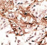 MAP1LC3C / LC3C Antibody - Formalin-fixed and paraffin-embedded human cancer tissue reacted with the primary antibody, which was peroxidase-conjugated to the secondary antibody, followed by AEC staining. This data demonstrates the use of this antibody for immunohistochemistry; clinical relevance has not been evaluated. BC = breast carcinoma; HC = hepatocarcinoma.