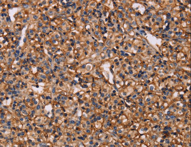 MAP1LC3C / LC3C Antibody - Immunohistochemistry of paraffin-embedded Human prostate cancer using MAP1LC3C Polyclonal Antibody at dilution of 1:40.