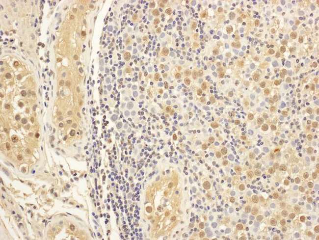 MAP1S Antibody - Detection of Human MAP1S by Immunohistochemistry. Sample: FFPE section of human testicular seminoma. Antibody: Affinity purified rabbit anti-MAP1S used at a dilution of 1:200 (1 ug/ml). Detection: DAB.