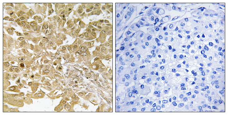 MAP2K1 / MKK1 / MEK1 Antibody - Immunohistochemistry analysis of paraffin-embedded human breast carcinoma tissue, using MEK1 Antibody. The picture on the right is blocked with the synthesized peptide.