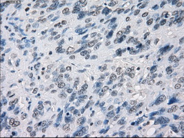 MAP2K1 / MKK1 / MEK1 Antibody - Immunohistochemical staining of paraffin-embedded Carcinoma of bladder tissue using anti-MAP2K1 mouse monoclonal antibody. (Dilution 1:50).