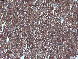 MAP2K1 / MKK1 / MEK1 Antibody - IHC of paraffin-embedded Human lymphoma tissue using anti-MAP2K1 mouse monoclonal antibody.
