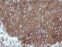 MAP2K1 / MKK1 / MEK1 Antibody - IHC of paraffin-embedded Carcinoma of Human lung tissue using anti-MAP2K1 mouse monoclonal antibody.