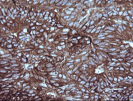 MAP2K1 / MKK1 / MEK1 Antibody - IHC of paraffin-embedded Adenocarcinoma of Human ovary tissue using anti-MAP2K1 mouse monoclonal antibody. (Heat-induced epitope retrieval by 10mM citric buffer, pH6.0, 120°C for 3min).