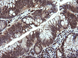 MAP2K1 / MKK1 / MEK1 Antibody - IHC of paraffin-embedded Adenocarcinoma of Human colon tissue using anti-MAP2K1 mouse monoclonal antibody. (Heat-induced epitope retrieval by 10mM citric buffer, pH6.0, 120°C for 3min).