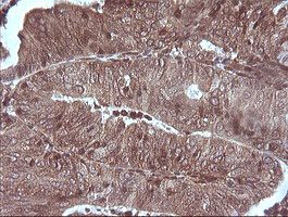 MAP2K1 / MKK1 / MEK1 Antibody - IHC of paraffin-embedded Adenocarcinoma of Human endometrium tissue using anti-MAP2K1 mouse monoclonal antibody. (Heat-induced epitope retrieval by 10mM citric buffer, pH6.0, 120°C for 3min).