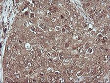 MAP2K1 / MKK1 / MEK1 Antibody - IHC of paraffin-embedded Carcinoma of Human lung tissue using anti-MAP2K1 mouse monoclonal antibody.