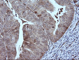 MAP2K1 / MKK1 / MEK1 Antibody - IHC of paraffin-embedded Adenocarcinoma of Human endometrium tissue using anti-MAP2K1 mouse monoclonal antibody.