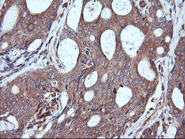 MAP2K1 / MKK1 / MEK1 Antibody - IHC of paraffin-embedded Adenocarcinoma of Human breast tissue using anti-MAP2K1 mouse monoclonal antibody. (Heat-induced epitope retrieval by 10mM citric buffer, pH6.0, 120°C for 3min).