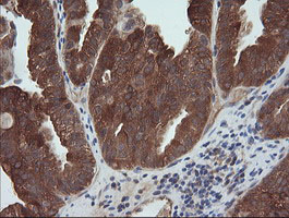 MAP2K1 / MKK1 / MEK1 Antibody - IHC of paraffin-embedded Adenocarcinoma of Human ovary tissue using anti-MAP2K1 mouse monoclonal antibody. (Heat-induced epitope retrieval by 10mM citric buffer, pH6.0, 120°C for 3min).