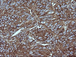 MAP2K1 / MKK1 / MEK1 Antibody - IHC of paraffin-embedded Adenocarcinoma of Human ovary tissue using anti-MAP2K1 mouse monoclonal antibody.