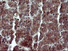 MAP2K1 / MKK1 / MEK1 Antibody - IHC of paraffin-embedded Carcinoma of Human liver tissue using anti-MAP2K1 mouse monoclonal antibody. (Heat-induced epitope retrieval by 10mM citric buffer, pH6.0, 120°C for 3min).