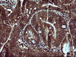 MAP2K1 / MKK1 / MEK1 Antibody - IHC of paraffin-embedded Carcinoma of Human pancreas tissue using anti-MAP2K1 mouse monoclonal antibody. (Heat-induced epitope retrieval by 10mM citric buffer, pH6.0, 120°C for 3min).