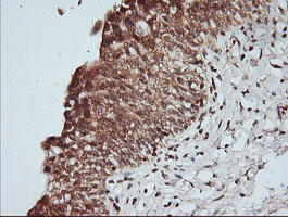 MAP2K1 / MKK1 / MEK1 Antibody - IHC of paraffin-embedded Carcinoma of Human prostate tissue using anti-MAP2K1 mouse monoclonal antibody.