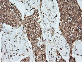 MAP2K1 / MKK1 / MEK1 Antibody - IHC of paraffin-embedded Carcinoma of Human bladder tissue using anti-MAP2K1 mouse monoclonal antibody.