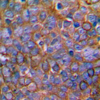 MAP2K1 / MKK1 / MEK1 Antibody - Immunohistochemical analysis of MKK1 staining in human prostate cancer formalin fixed paraffin embedded tissue section. The section was pre-treated using heat mediated antigen retrieval with sodium citrate buffer (pH 6.0). The section was then incubated with the antibody at room temperature and detected using an HRP conjugated compact polymer system. DAB was used as the chromogen. The section was then counterstained with hematoxylin and mounted with DPX.
