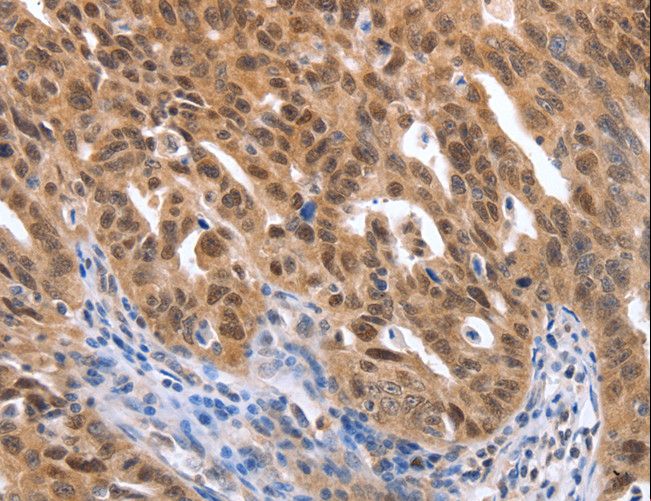 MAP2K1 / MKK1 / MEK1 Antibody - Immunohistochemistry of paraffin-embedded Human ovarian cancer using MAP2K1 Polyclonal Antibody at dilution of 1:25.