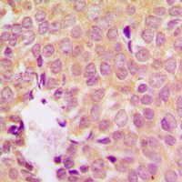 MAP2K1 / MKK1 / MEK1 Antibody - Immunohistochemical analysis of MKK1 (pS298) staining in human breast cancer formalin fixed paraffin embedded tissue section. The section was pre-treated using heat mediated antigen retrieval with sodium citrate buffer (pH 6.0). The section was then incubated with the antibody at room temperature and detected using an HRP conjugated compact polymer system. DAB was used as the chromogen. The section was then counterstained with hematoxylin and mounted with DPX.
