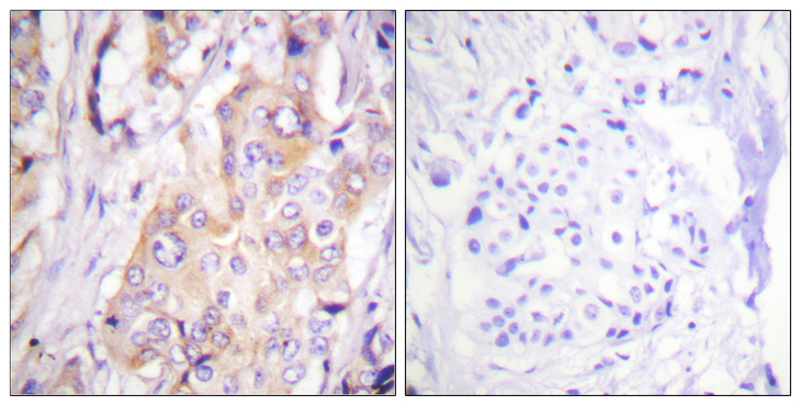 MAP2K1 / MKK1 / MEK1 Antibody - Immunohistochemistry analysis of paraffin-embedded human breast carcinoma, using MEK1 (Phospho-Thr286) Antibody. The picture on the right is blocked with the phospho peptide.