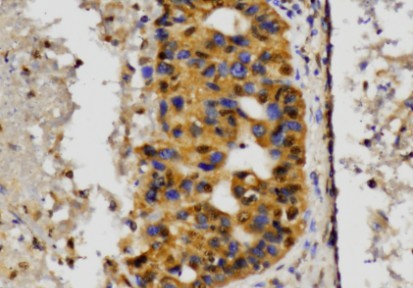 MAP2K1 / MKK1 / MEK1 Antibody - IHC of MEK1 (P293) pAb in paraffin-embedded human hepatic carcinoma tissue.