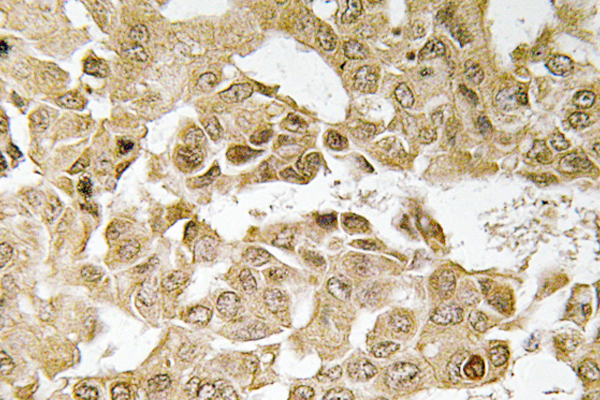 MAP2K1 / MKK1 / MEK1 Antibody - IHC of MEK1 (T286) pAb in paraffin-embedded human breast carcinoma tissue.