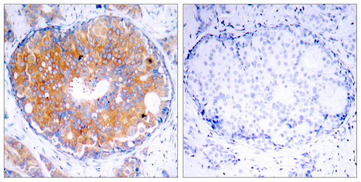 MAP2K2 / MKK2 / MEK2 Antibody - Immunohistochemistry analysis of paraffin-embedded human breast carcinoma, using MEK2 Antibody. The picture on the right is blocked with the synthesized peptide.