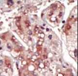 MAP2K2 / MKK2 / MEK2 Antibody - Formalin-fixed and paraffin-embedded human cancer tissue reacted with the primary antibody, which was peroxidase-conjugated to the secondary antibody, followed by DAB staining. This data demonstrates the use of this antibody for immunohistochemistry; clinical relevance has not been evaluated. BC = breast carcinoma; HC = hepatocarcinoma.