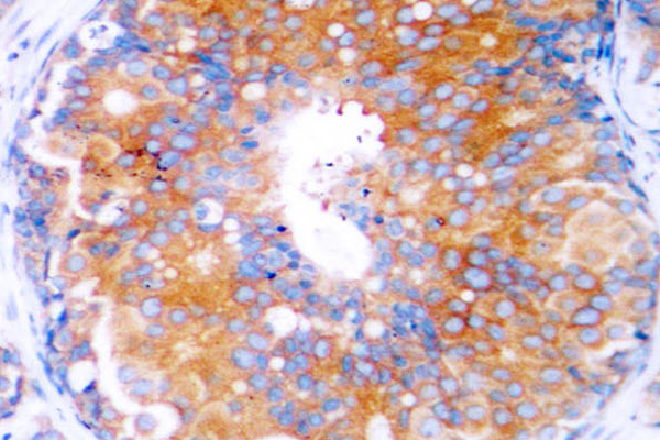 MAP2K2 / MKK2 / MEK2 Antibody - IHC of MEK2 (R388) pAb in paraffin-embedded human breast carcinoma tissue.