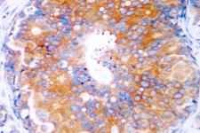 MAP2K2 / MKK2 / MEK2 Antibody - IHC of MEK2 (R388) pAb in paraffin-embedded human breast carcinoma tissue.