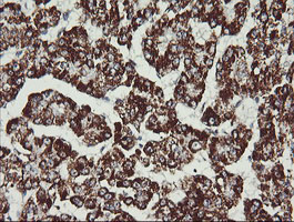 MAP2K2 / MKK2 / MEK2 Antibody - IHC of paraffin-embedded Carcinoma of Human liver tissue using anti-MAP2K2 mouse monoclonal antibody. (Heat-induced epitope retrieval by 10mM citric buffer, pH6.0, 120°C for 3min).