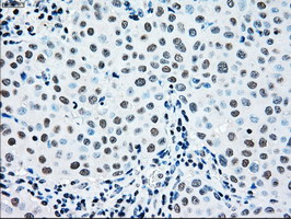 MAP2K2 / MKK2 / MEK2 Antibody - IHC of paraffin-embedded Adenocarcinoma of breast tissue using anti-MAP2K2 mouse monoclonal antibody. (Dilution 1:50).