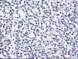 MAP2K2 / MKK2 / MEK2 Antibody - IHC of paraffin-embedded Carcinoma of thyroid tissue using anti-MAP2K2 mouse monoclonal antibody. (Dilution 1:50).