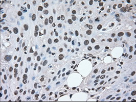 MAP2K2 / MKK2 / MEK2 Antibody - IHC of paraffin-embedded Carcinoma of pancreas tissue using anti-MAP2K2 mouse monoclonal antibody. (Dilution 1:50).