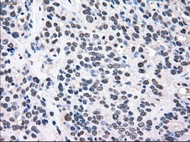 MAP2K2 / MKK2 / MEK2 Antibody - IHC of paraffin-embedded Carcinoma of bladder tissue using anti-MAP2K2 mouse monoclonal antibody. (Dilution 1:50).