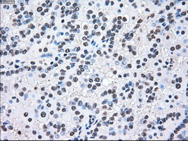 MAP2K2 / MKK2 / MEK2 Antibody - IHC of paraffin-embedded Carcinoma of kidney tissue using anti-MAP2K2 mouse monoclonal antibody. (Dilution 1:50).