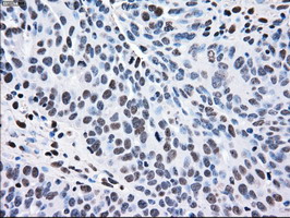 MAP2K2 / MKK2 / MEK2 Antibody - IHC of paraffin-embedded Adenocarcinoma of ovary tissue using anti-MAP2K2 mouse monoclonal antibody. (Dilution 1:50).