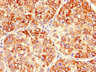 MAP2K2 / MKK2 / MEK2 Antibody - Immunohistochemistry of paraffin-embedded human liver cancer using MAP2K2 Antibody at dilution of 1:100