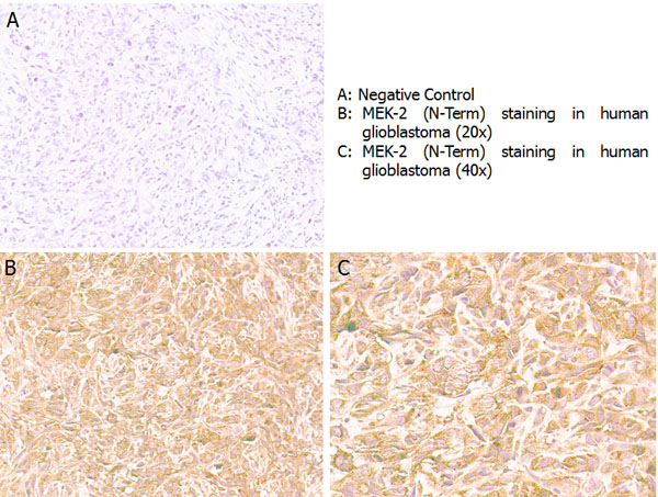 MAP2K2 / MKK2 / MEK2 Antibody - Immunohistochemistry with anti-MEK2 (N-Term) antibody showing positive staining in human glioblastoma tissue at 20x and 40x (B & C). Staining was performed on Leica Bond system using the standard protocol. Formalin fixed/paraffin embedded tissue sections were subjected to antigen retrieval and then incubated with rabbit anti-MEK2 (N-Term) antibody at 1:100 dilution for 60 minutes. Biotinylated Anti-rabbit secondary antibody was used at 1:200 dilution to detect primary antibody. The reaction was developed using streptavidin-HRP conjugated compact polymer system and visualized with chromogen substrate, 3?-diamino-benzidine substrate (DAB). The sections were then counterstained with hematoxylin to detect cell nuclei.