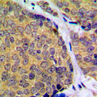 MAP2K2 / MKK2 / MEK2 Antibody - Immunohistochemical analysis of MKK2 (pT394) staining in human breast cancer formalin fixed paraffin embedded tissue section. The section was pre-treated using heat mediated antigen retrieval with sodium citrate buffer (pH 6.0). The section was then incubated with the antibody at room temperature and detected using an HRP conjugated compact polymer system. DAB was used as the chromogen. The section was then counterstained with hematoxylin and mounted with DPX.