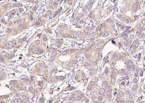 MAP2K2 / MKK2 / MEK2 Antibody - 1:100 staining human breast carcinoma tissue by IHC-P. The tissue was formaldehyde fixed and a heat mediated antigen retrieval step in citrate buffer was performed. The tissue was then blocked and incubated with the antibody for 1.5 hours at 22°C. An HRP conjugated goat anti-rabbit antibody was used as the secondary.