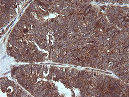 MAP2K3 / MEK3 / MKK3 Antibody - IHC of paraffin-embedded Adenocarcinoma of Human ovary tissue using anti-MAP2K3 mouse monoclonal antibody. (Heat-induced epitope retrieval by 10mM citric buffer, pH6.0, 120°C for 3min).