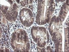 MAP2K3 / MEK3 / MKK3 Antibody - IHC of paraffin-embedded Adenocarcinoma of Human colon tissue using anti-MAP2K3 mouse monoclonal antibody.