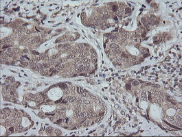 MAP2K3 / MEK3 / MKK3 Antibody - IHC of paraffin-embedded Adenocarcinoma of Human breast tissue using anti-MAP2K3 mouse monoclonal antibody.