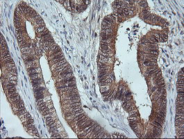 MAP2K3 / MEK3 / MKK3 Antibody - IHC of paraffin-embedded Adenocarcinoma of Human colon tissue using anti-MAP2K3 mouse monoclonal antibody.