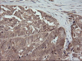 MAP2K3 / MEK3 / MKK3 Antibody - IHC of paraffin-embedded Adenocarcinoma of Human ovary tissue using anti-MAP2K3 mouse monoclonal antibody.
